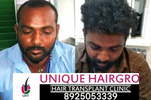 Unique Hair Gro Before & After (1)