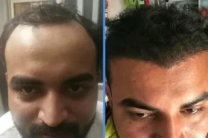 hair growth before after