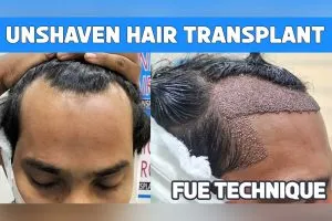 Unshaven hair transplant - FUE technique