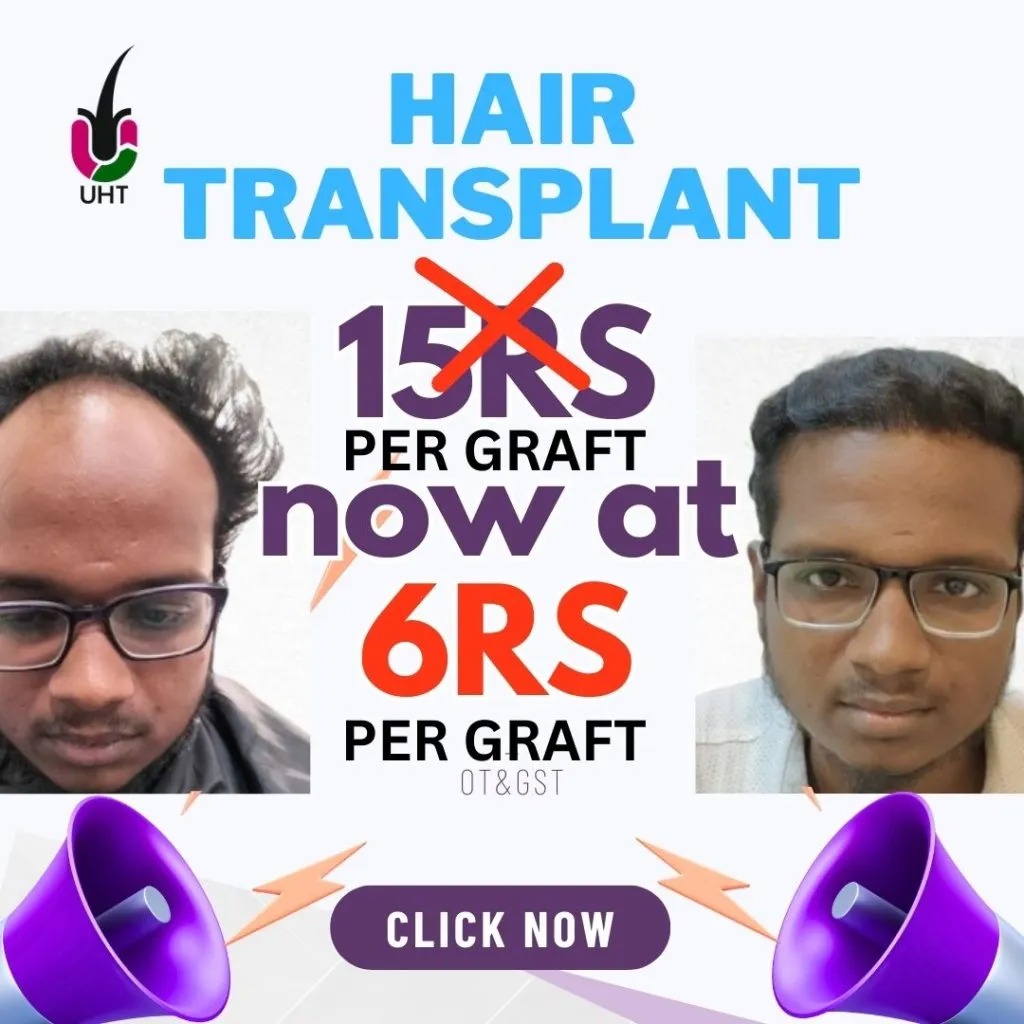 hair transplant new offer